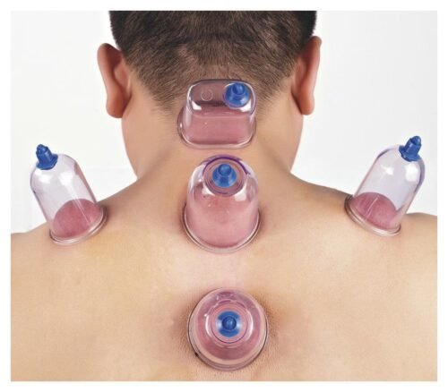 What is Cupping Therapy in detail
