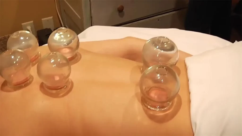Who is not suitable for cupping therapy?