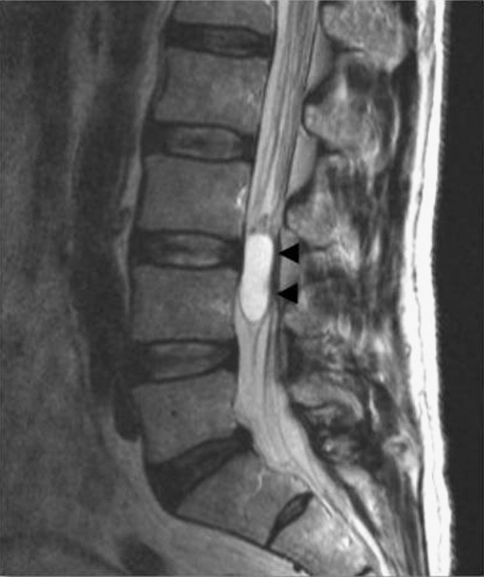 What are the signs and symptoms of spinal tumors
