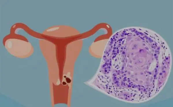 Take care of the health of the uterus