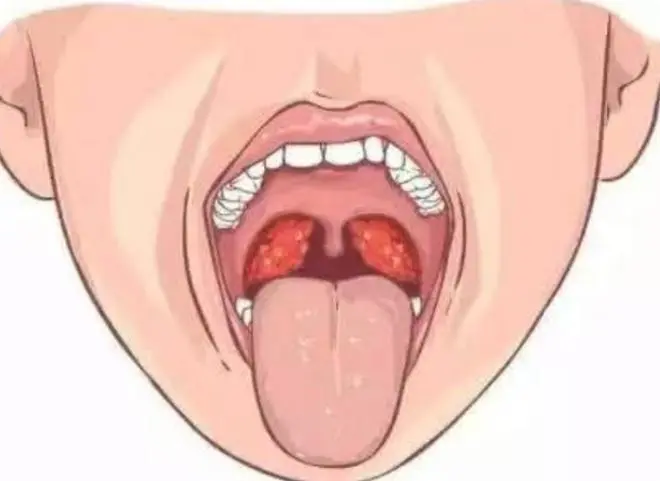 Organ 1: Tonsils