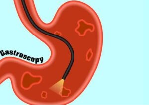 Best food for upset stomach and acid reflux