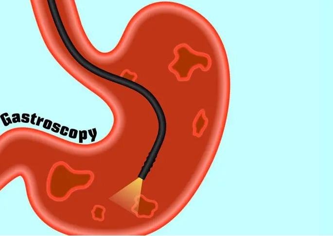 Best food for upset stomach and acid reflux