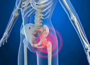 Can arthritis hip pain come on suddenly