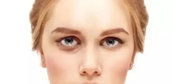 How to tighten eyelids at home