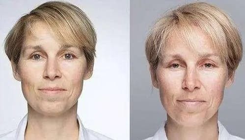 How to choose a facelift