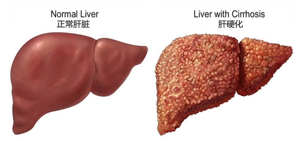 Can liver cirrhosis be cured?